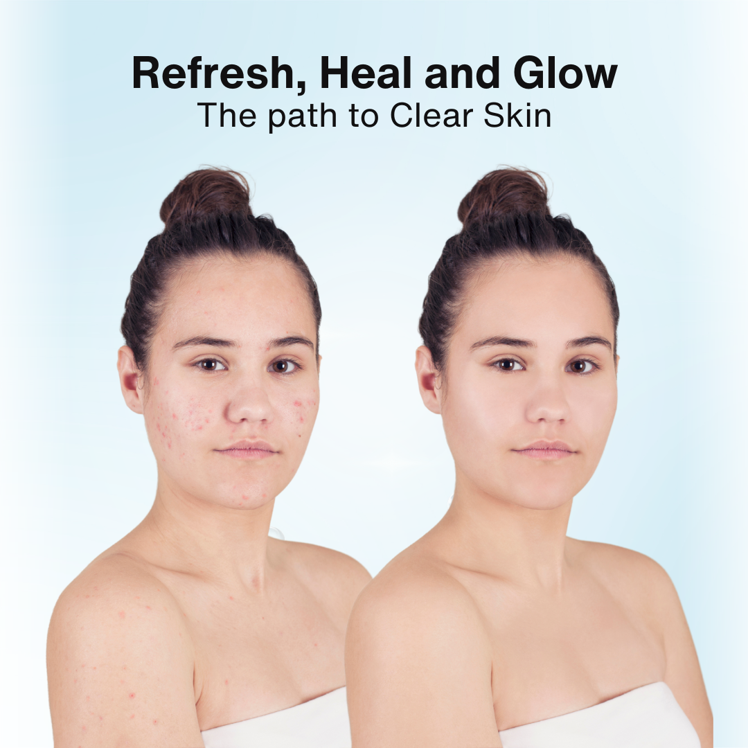 Clearskin Plus Anti Acne Facewash